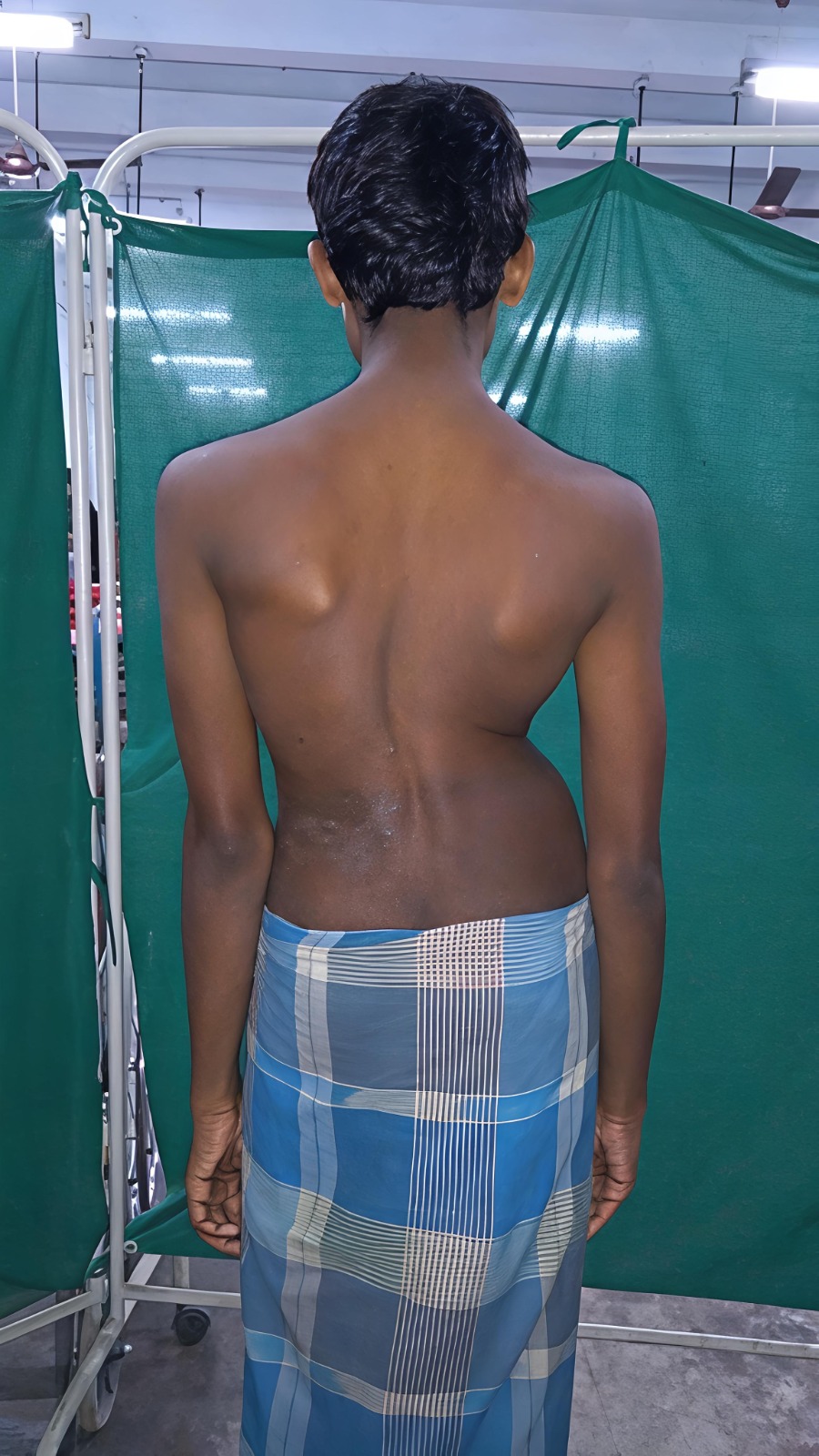 স্কোলিওসিস১