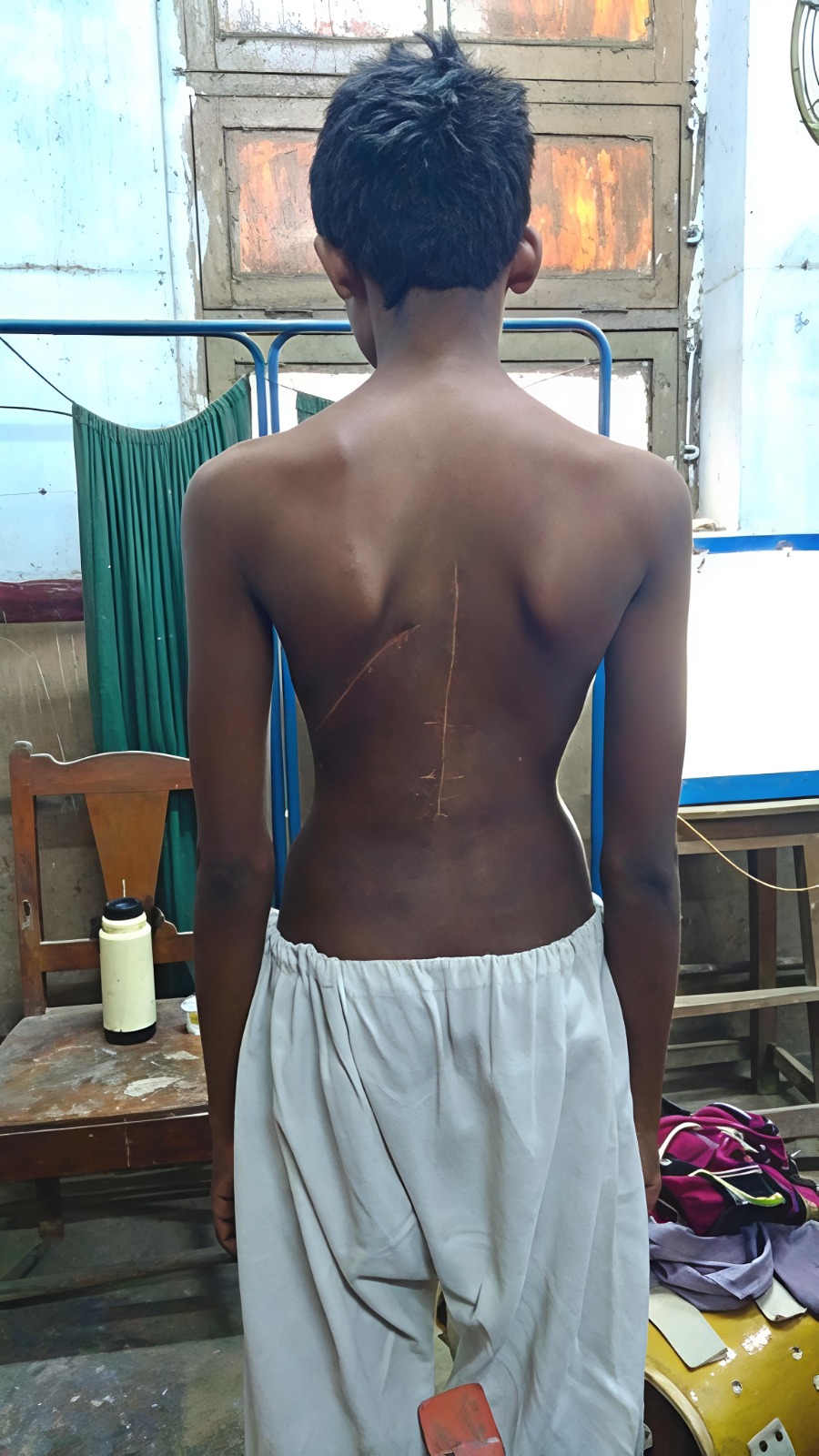 স্কোলিওসিস২