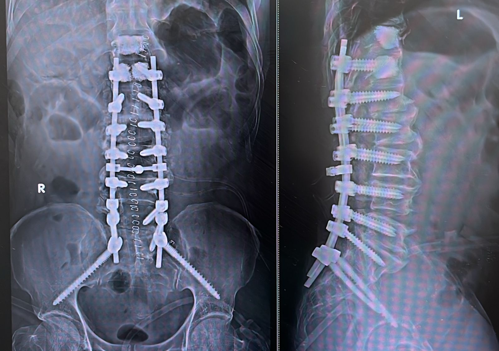 SPINE SURGERY